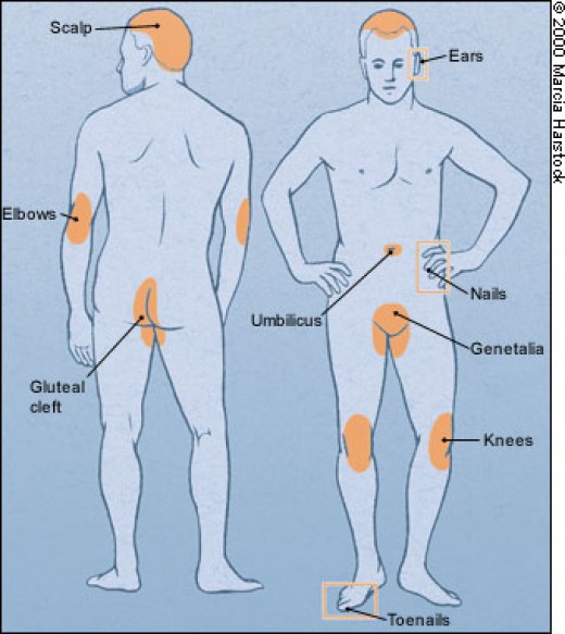 Best treatment for scabies in adults