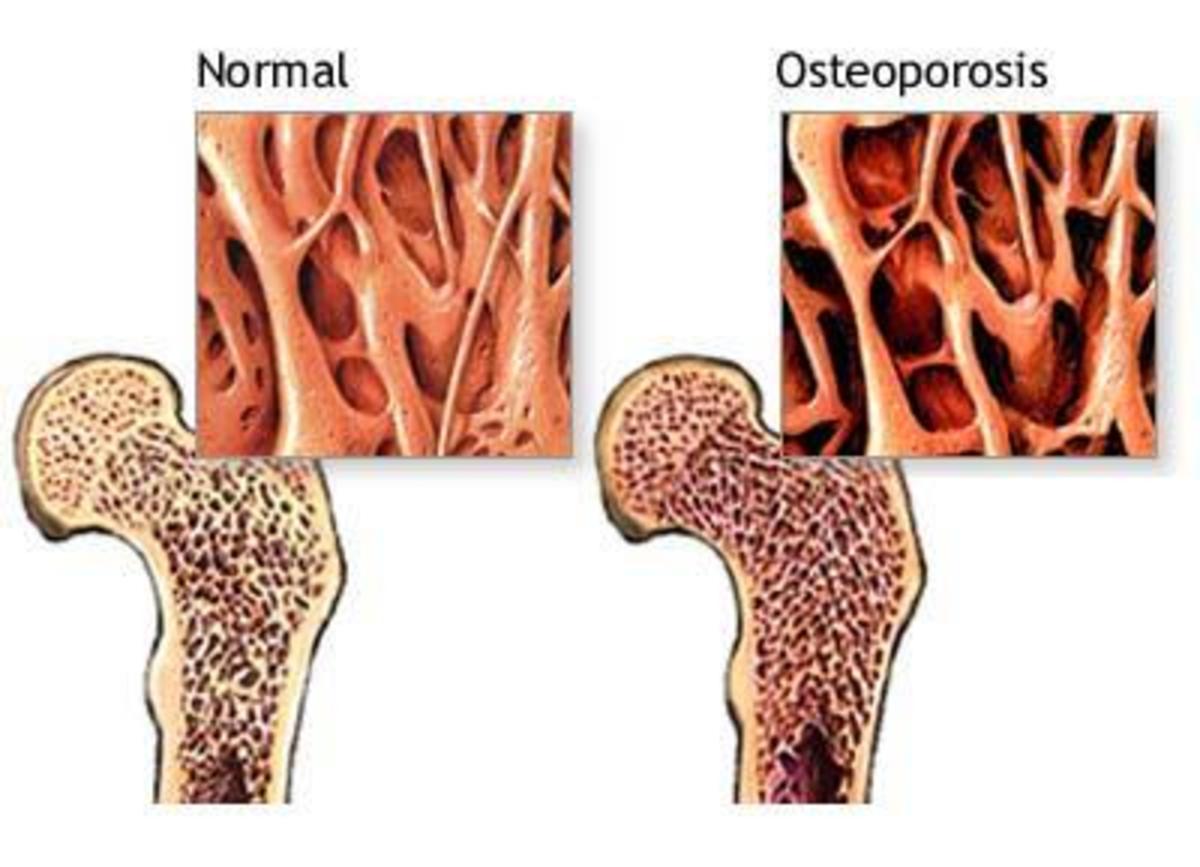 Before and after Osteoporosis