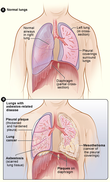 An illustration demonstrating both Asbestosis and Mesothelioma