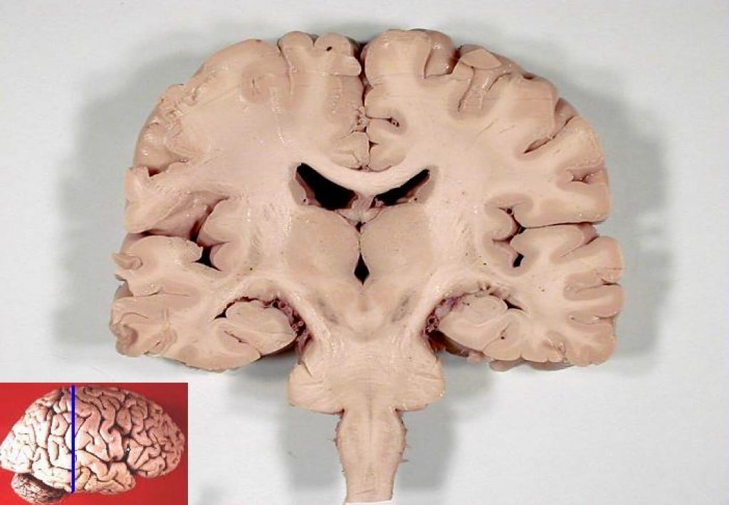 about-brain-atrophy-in-ms-hubpages