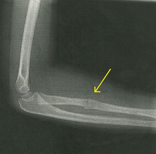 My Daughter's X-Ray