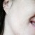 Here is my photo after 2 IPL treatments Here is my photo after 2 IPL treatments