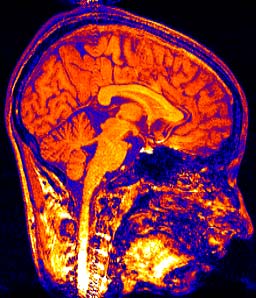 migraine associated vertigo