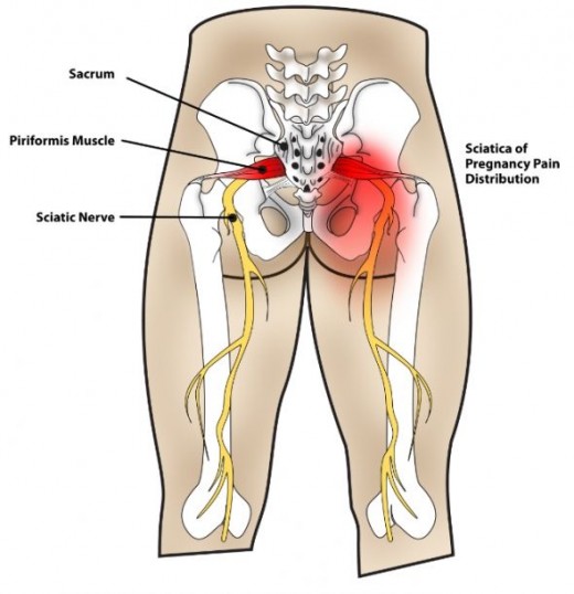 Tight Muscles In Lower Back And Hip Area : Tight lower ...