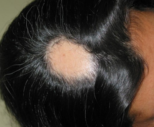 Alopecia