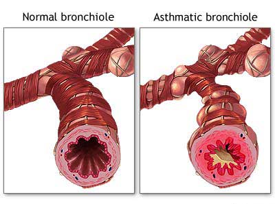 Notice the mucus in the asthmatic bronchial tubes versus the healthy.