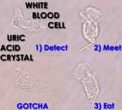 Uric Acid Cyrstals