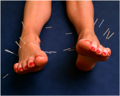 Acupuncture of blisters?