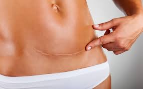 Scars from a C. section don't heal quickly and need to be aken care of for it to look like this
