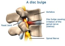 bulging disc