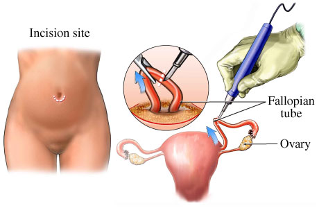 Postpartum tubaligation