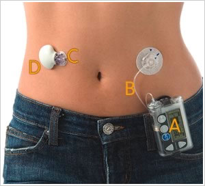 A - The Pump itself B- The Cannula C -Continuous Glucose Monitoring Sensor