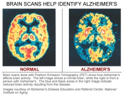 I forgot to tell you I have Alzheimer's disease!