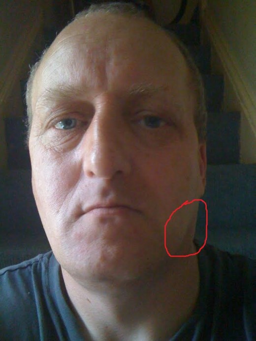 Picture taken the day after I discovered the lump. as you can see I don't have a steady hand when drawing a circle in Paint.