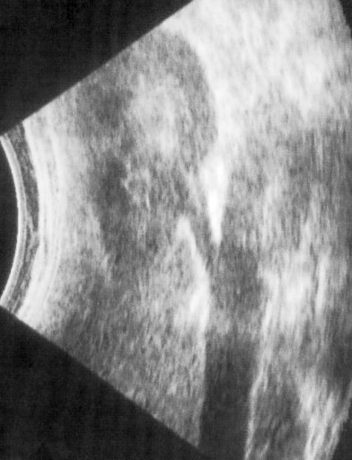 An Ultrasound scan uses sound waves to give a picture of inside the body without the need for surgery.