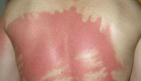 Severe sunburn can lead to skin cancer 