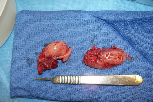 Speaking. What can adults eat after tonsillectomy can Very What can adults eat after tonsillectomy necessary words
