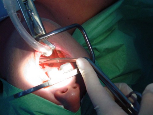 What to Expect From an Adult Tonsillectomy What to Expect From an Adult Tonsillectomy