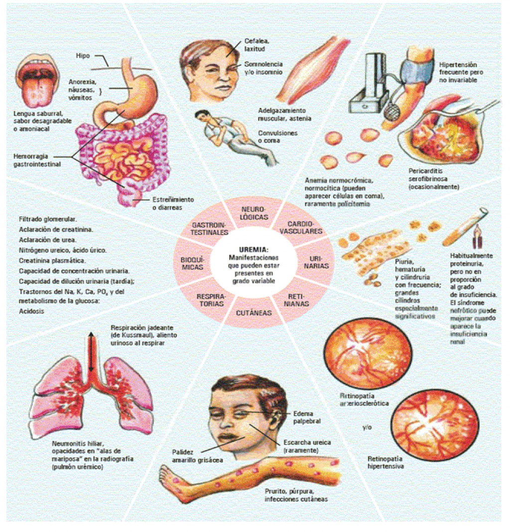 What is Uremia?