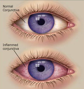 One normal eye & one infected eye