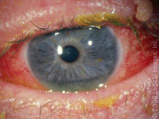 If you have an eye like this, see your doctor right away.