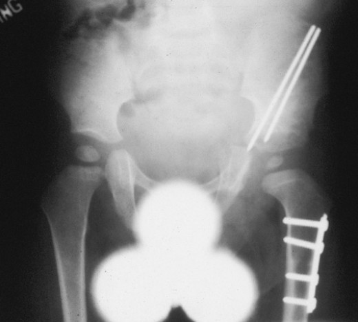 right hip dysplasia icd 10 code