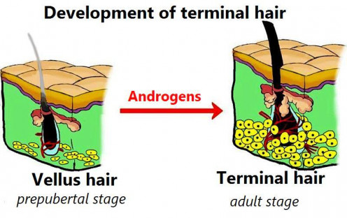 How androgens convert vellus hair to terminal hair. Modified and translated file under sharealike license on Creative Commons.