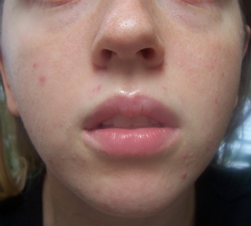 Obagi Nu-derm Results: Week 1 | HubPages