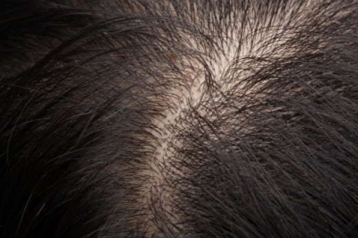 How to Get Rid of Folliculitis on Your Scalp | HubPages