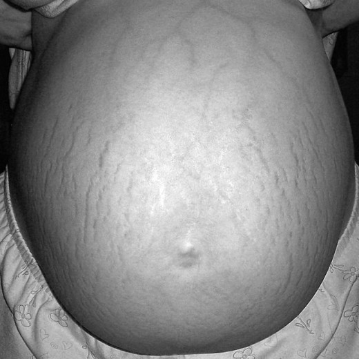 Stretch marks on a mother just weeks before giving birth.