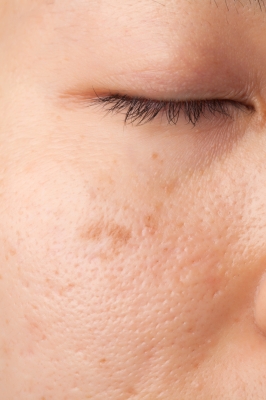 Scar Skin Problem