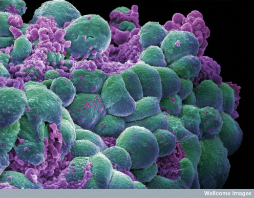 A cluster of Breast cancer Cells
