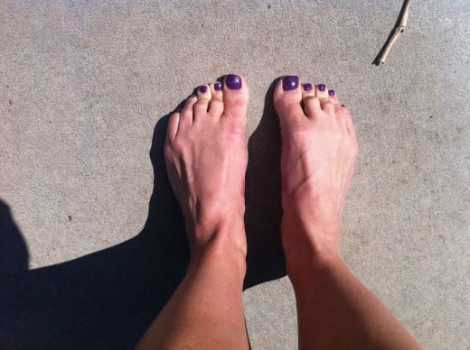 Athletes Toes