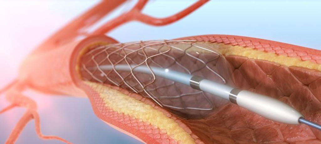 Angioplasty Surgery, Recovery and Lifestyle Changes | hubpages