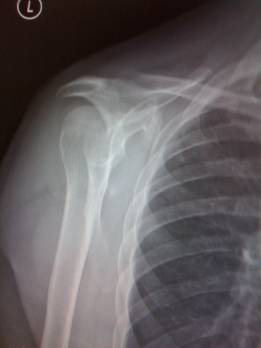 X-ray of the joint the rotator cuff supports.