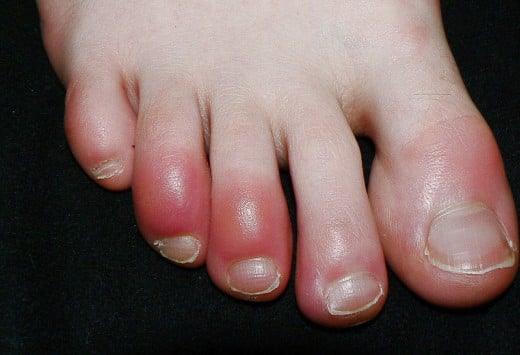 Chilblains, Boils, And Carbuncles: Three Painful Skin Problems 