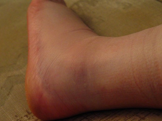 Pain, stiffness, swelling or all of the above are common symptoms of a sprained or fractured ankle.