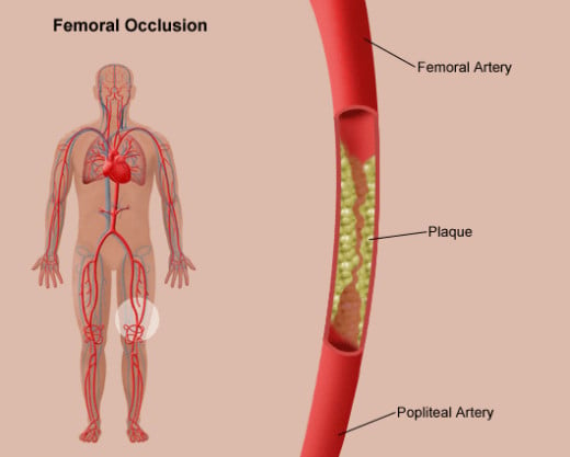 These pictures demonstrates atherosclerosis, or plaque build up in between the femoral and popliteal artery.