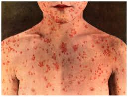 Adult measles as it usually presents in widespread rash.