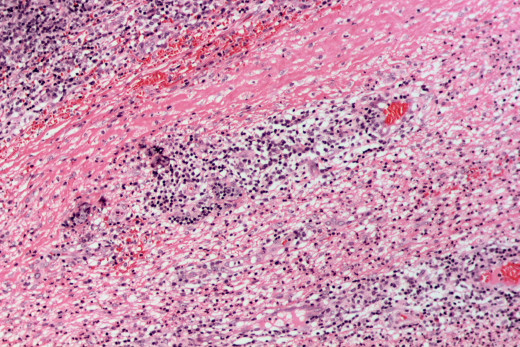 An abscess of the tonsils may require a surgical procedure to remove it.