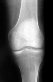 X-rays are one way that psoriatic arthritis is detected. 