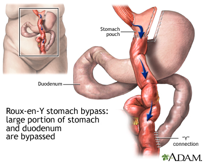 The Roux-en-Y gastric bypass procedure involves creating a stomach pouch out of a small portion of the stomach and attaching it directly to the small intestine, bypassing a large part of the stomach and duodenum. 