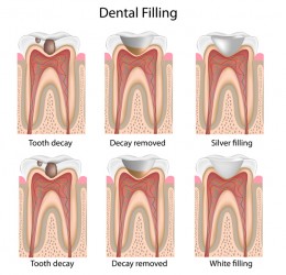 Dental Filling