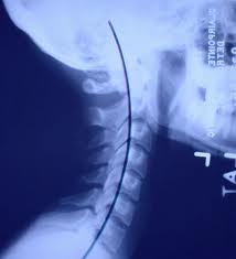 Normal Alignment of Vertebrae (C curve)