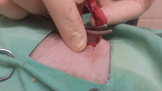 The left ovary has been elevated- it can be seen just above the two metal forceps.