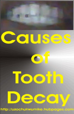 Causes of Tooth decay