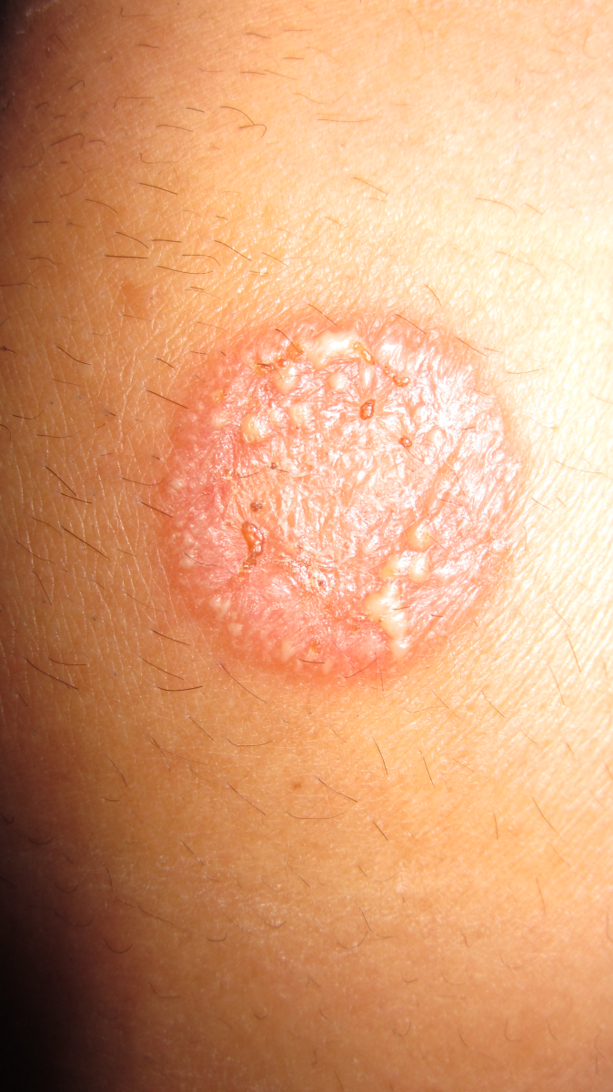 rash with bumps
