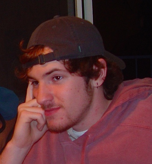 Me before the surgery. You can notice the bottom lip jutting forward a bit. 