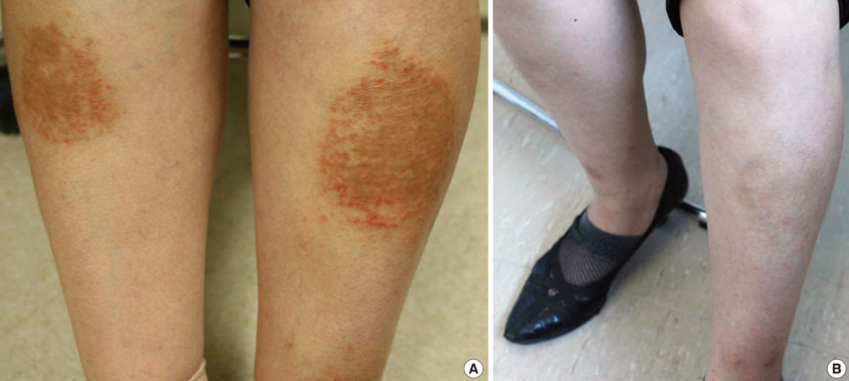 Can Leggings Cause Rash On Legs And Arms
