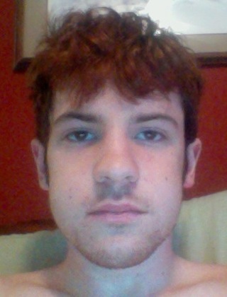 Third day after surgery and looking puffy!